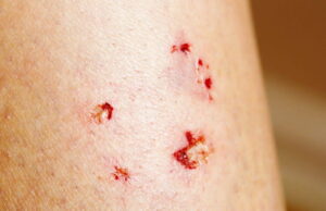 INFORMAN A LA CIUDADANÍA SOBRE CÓMO ACTUAR EN CASO DE MORDEDURAS DE ANIMALES