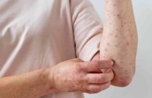 BAJA CALIFORNIA SIN CASOS DE VIRUELA SÍMICA: SALUD