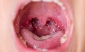 AUMENTAN LOS CONTAGIOS DE ESCARLATINA EN MÉXICO; BC LA SEXTA ENTIDAD CON MÁS CONTAGIOS